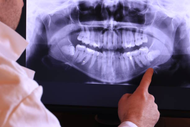 Best Emergency Dentist for Lost Fillings or Crowns in Medina, WA